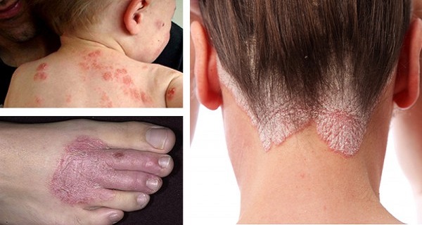 12 Natural Remedies For Eczema, Rashes and a Range of Persistent Skin Conditions