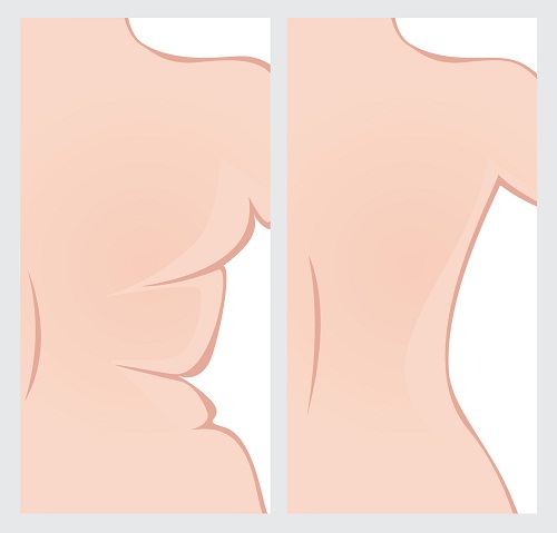 Back right side before and after weight loss