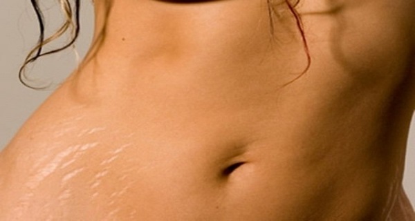 Simple Home Remedies To Do Away With Stretch Marks In No Time