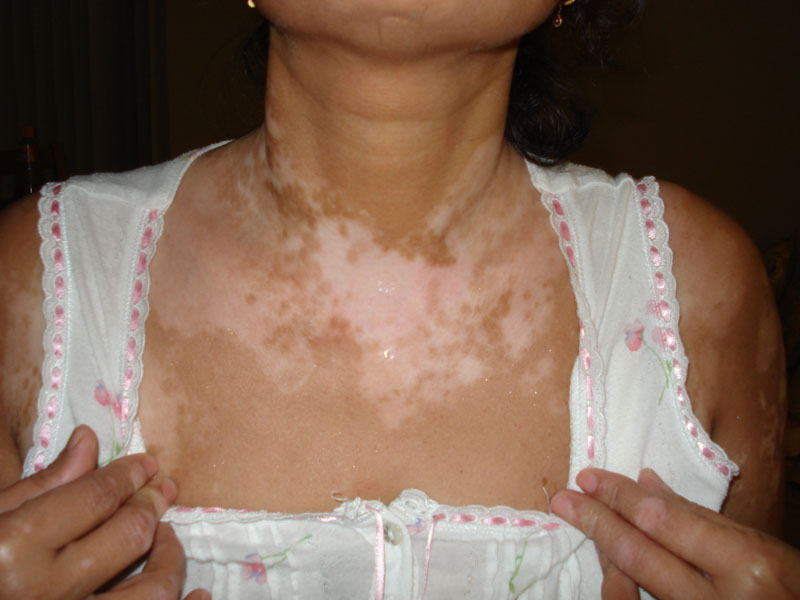 Vitiligo
