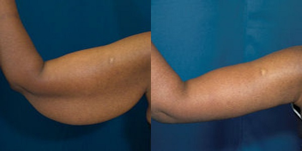 arm-lift-before-after-fl-237