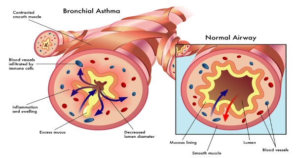 bigstock-bronchial-asthma