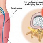 5 Simplest Magical Pain Removing Methods If You’re Suffering from Sciatica Pain image-7215