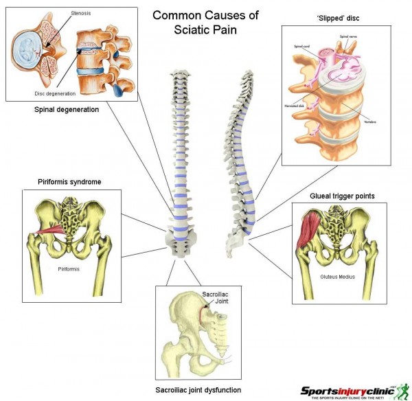 sciatica-diagram