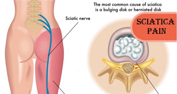sciatica