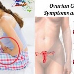 Never Ignore this Early Signs of Ovarian Cancer – Symptoms and Signs! image-7940