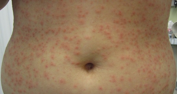 13 Home Remedies for Folliculitis