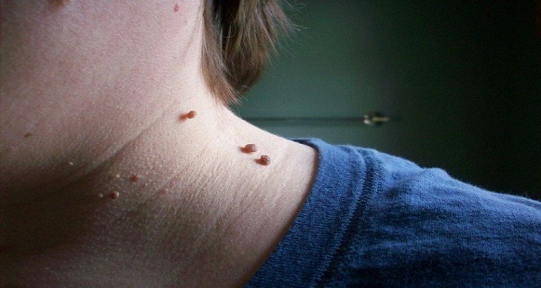 20 Simple Home Remedies for Skin Tag Removal