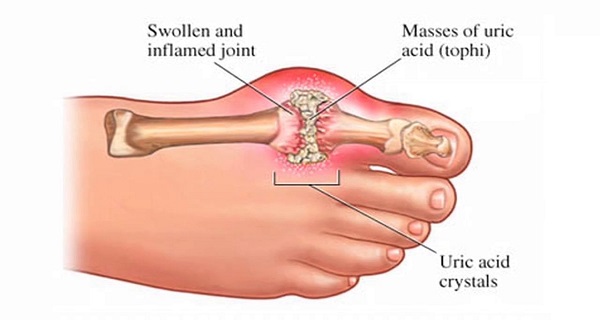 7 Natural Remedies That Help to Remove The Uric Acid That Causes Arthritis