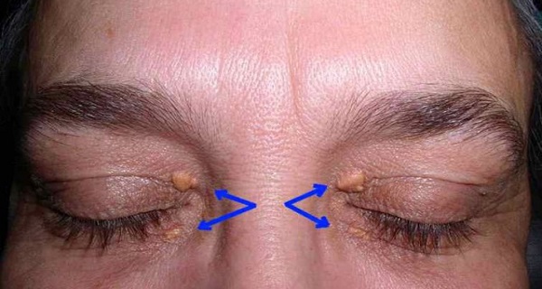 A MUST READ Warning Signs of a Heart Attack Can be Found on Your Eyelids