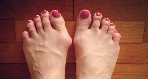 Ease Your Bunions in Just 10 Days with This Powerful Home Remedy