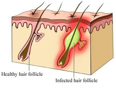 How To Get Rid Of Boils On Inner Thighs And Buttocks 1
