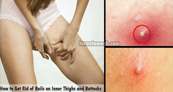 How To Get Rid Of Boils On Inner Thighs And Buttocks