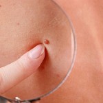 How To Remove Moles Naturally? image-8523