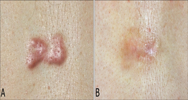 How Useful Is Tea Tree Oil In Treating Keloids