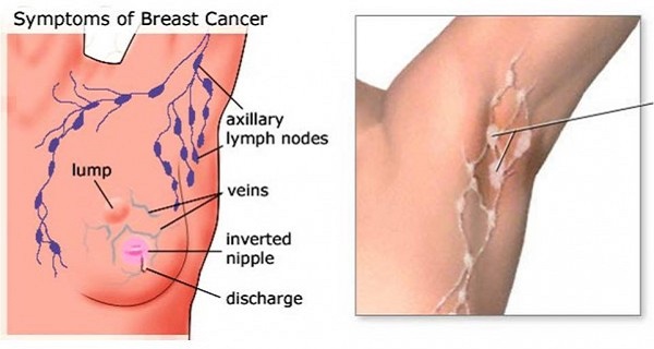 How to Prevent Breast Cancer Through An Armpit Detox!
