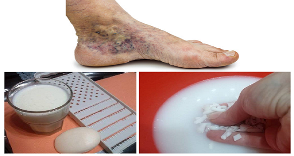 Magical Recipe for Varicose Veins and Thrombosis with Only 2 Simple Ingredients