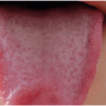 Natural Remedies for Disinfecting Your Tongue Naturally image-8146