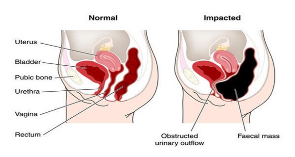 Say Goodbye To Belly Bloat Forever! Here Are 3 Simple Tips To Help You Flatten Your Stomach Starting Today!