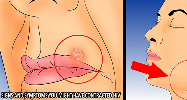 Signs and Symptoms You Might Have Contracted HIV