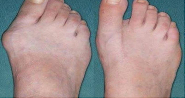 Amazing solution try to get Rid of this Bone just in 10 days ! Without Surgery !