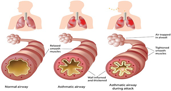 Cure Asthma with Just a Drop of This Amazing Home Remedy
