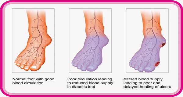 Do You Suffer From Poor Circulation Here Is How To Solve Your Problem In Just 20 Minutes!
