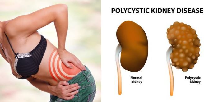 Early Symptoms of Kidney Disease and How to Keep Your Kidneys Healthy