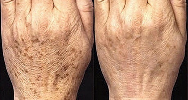 Remove Age Spots With The Best Homemade Exfoliating Scrub!