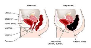 Say Goodbye To Belly Bloat Forever! Here Are 3 Simple Tips To Help You Flatten Your Stomach Starting Today 2