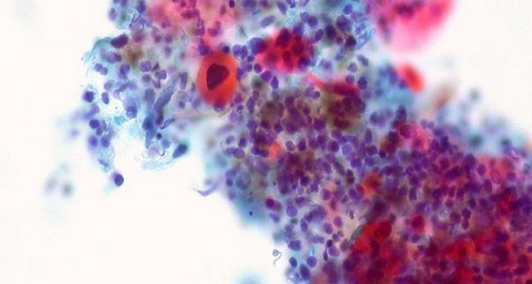 Scientists Have Found A Way To Make Cancer Cells Kill Each Other