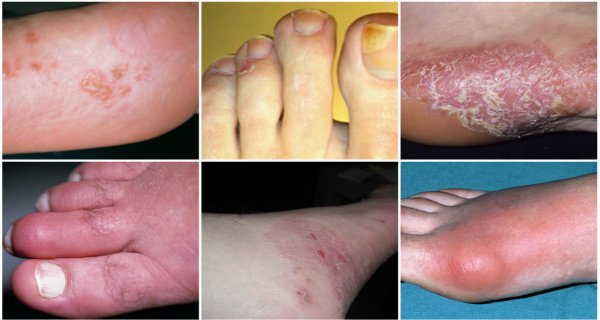TAKE A GOOD LOOK AT YOUR FEET THESE 10 Signs May Indicate a Serious Health Problem