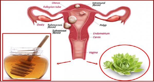 THE MIXTURE OF THESE 2 INGREDIENTS KILLS CYSTS AND FIBROIDS