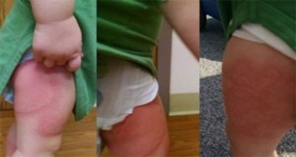 Warning! Child Woke Up With Mysterious Rashes, Parents Want To Warn Everyone Else To Be Cautious!