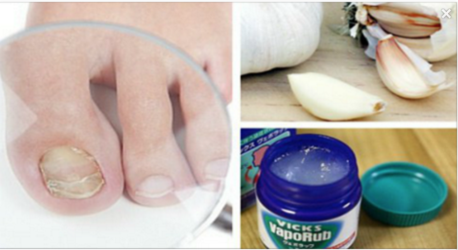 7 Home Remedies to Combat Fungal Toenails and Hands