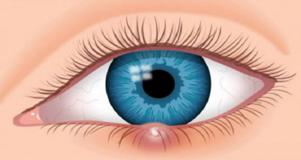How to Naturally and Quickly Cure an Eye Sty