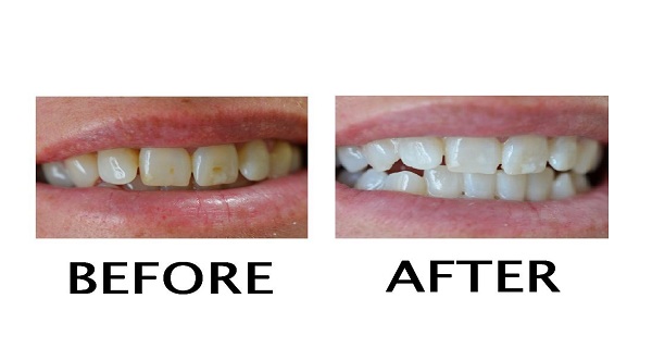 How to Remove Yellow Stains From Teeth