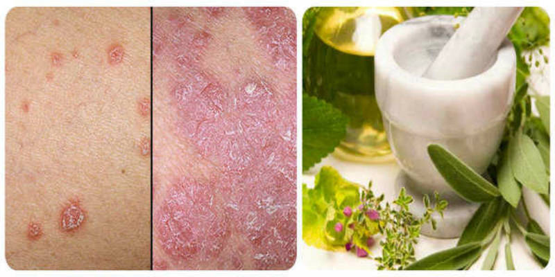 Natural Cure for the Psoriasis and Other Skin Diseases With This Recipe
