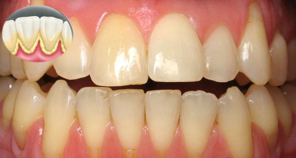 Use THIS One Ingredient to Whiten Your Teeth and Remove Plaque at Home