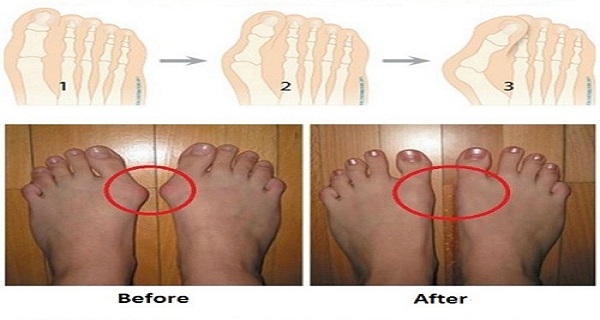 For This You Do Not Need Surgery 5 Ways To Remove The Knuckles And Heal Swollen Joints in Just 7 Days!