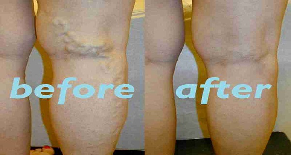The Best Home Remedies for Varicose Veins