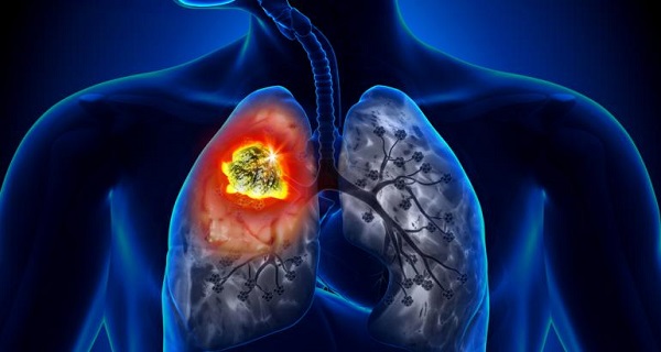 The Best Nutrition to Prevent Lung Cancer