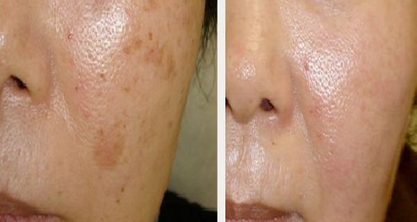 The Most Efficient Remedies to Remove Brown Spots on Your Face Naturally