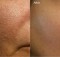 Get Rif of Large Pores for Good with This 2-Ingredient Super Effective Mask
