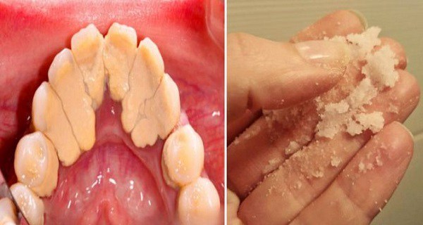 HERE-S-A-TRICK-TO-REMOVE-TARTAR-BUILDUP-AT-HOME-WITHIN-SECONDS