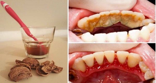 HOW TO GET RID OF TARTAR WITH ONE SIMPLE INGREDIENT
