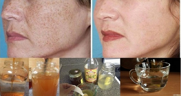 The Quickest and Most Effective Way to Erase Spots, Stains, and Scars from the Skin!