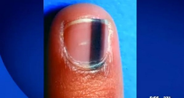 If You Ever Develop A Black Mark On Your Fingernail Like THIS
