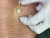 She’s Had This Weird Lump On Her Back For Years, But When The Doctor Cuts Into It…OMG!