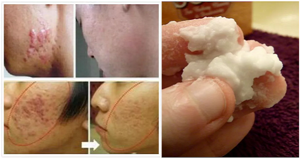 Wash Your Face with This Ingredient for Acne and Wrinkles Get Flawless Skin with Just One Ingredient! (VIDEO)